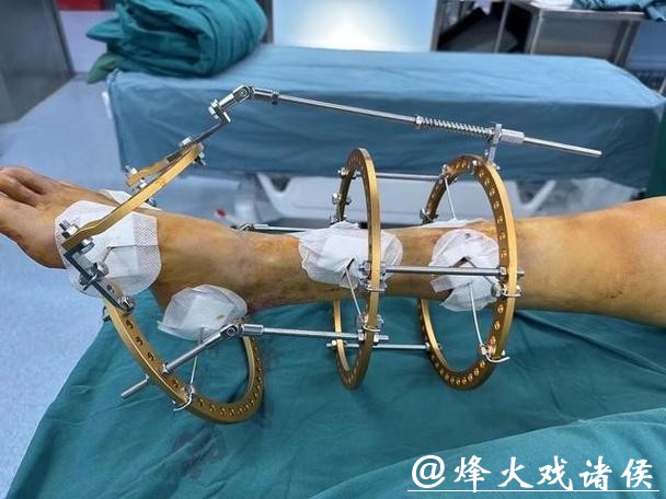 拜仁中场托利索接受脚踝手术