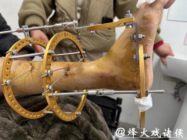 拜仁中场托利索接受脚踝手术